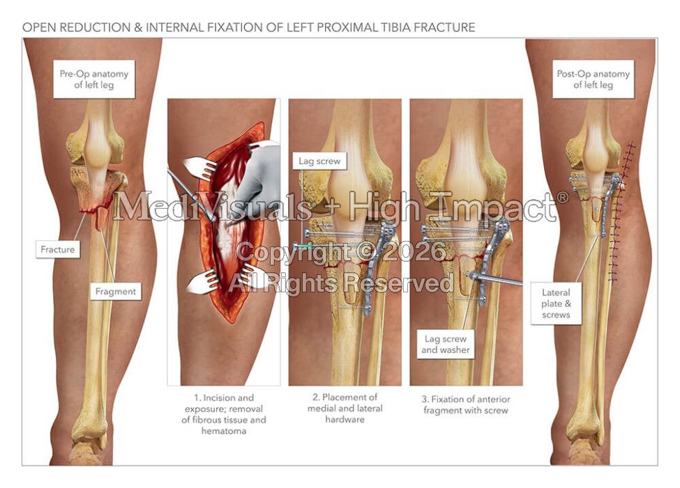 Open Reduction & Internal Fixation of Left Proximal Tibia Fracture