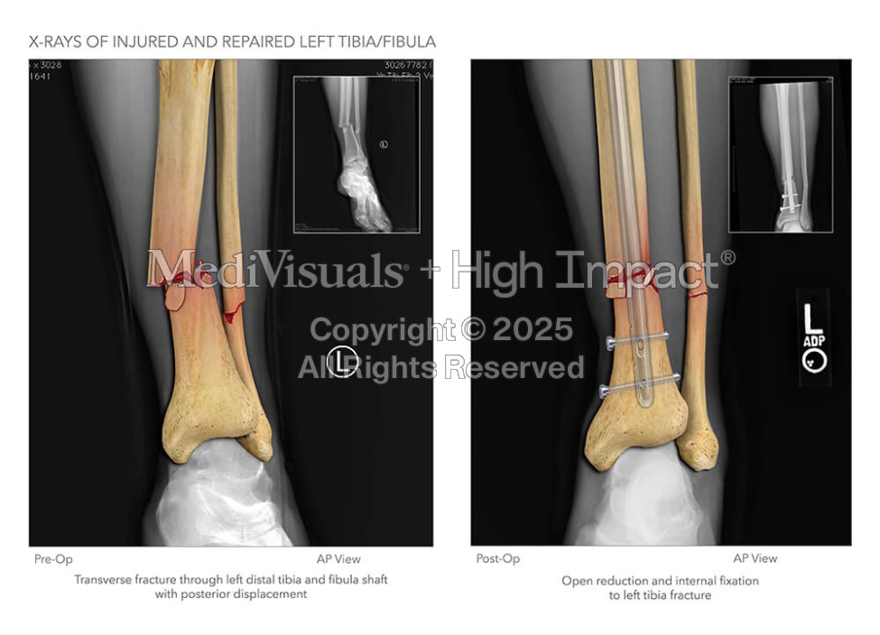 X-Rays of Injured and Repaired Left Tibia and Fibula