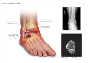 Right Ankle Injuries