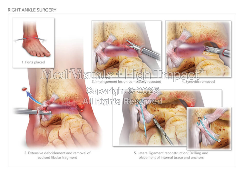 Right Ankle Surgery
