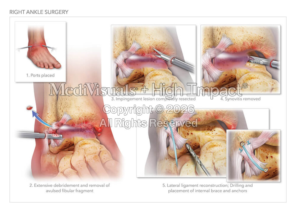 Right Ankle Surgery