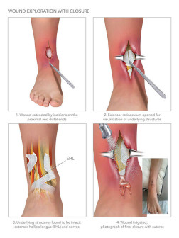 Wound Exploration with Closure