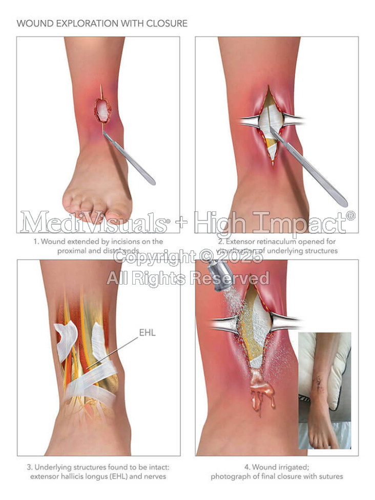 Wound Exploration with Closure