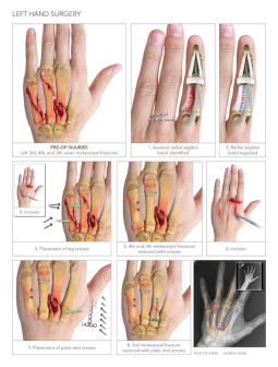 Left Hand Surgery
