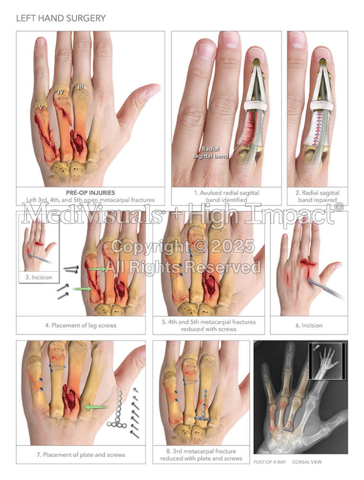 Left Hand Surgery