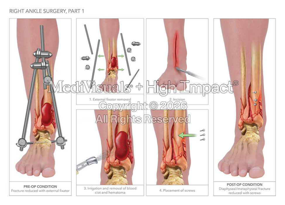 Right Ankle Surgery
