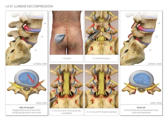 Lumbar Injuries