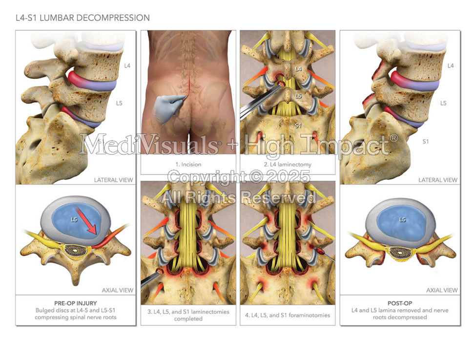 Lumbar Decompression