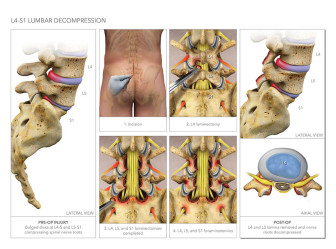 L4-S1 Lumbar Decompression