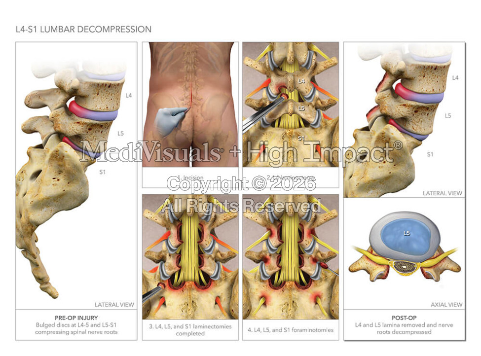 L4-S1 Lumbar Decompression