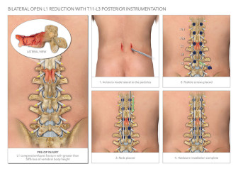 Bilateral Open Reduction with Posterior Instrumentation