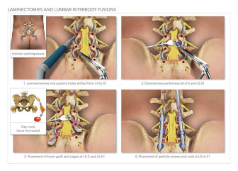 Laminectomies & Lumbar Interbody Fusions