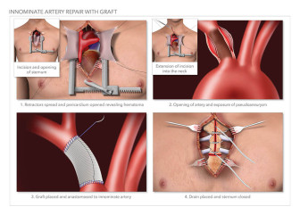 Innominate Artery Repair with Graft
