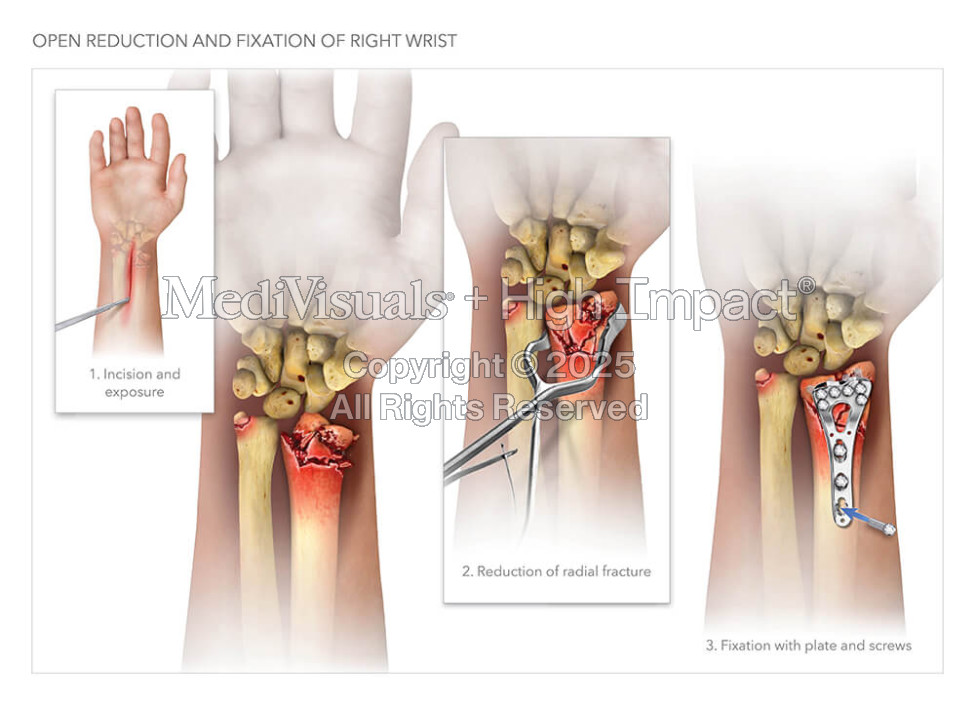 Open Reduction and Fixation of Right Wrist