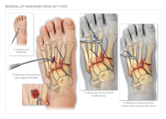 Removal of Hardware from Left Foot