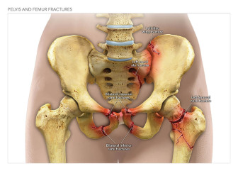 Pelvis and Femur Fractures