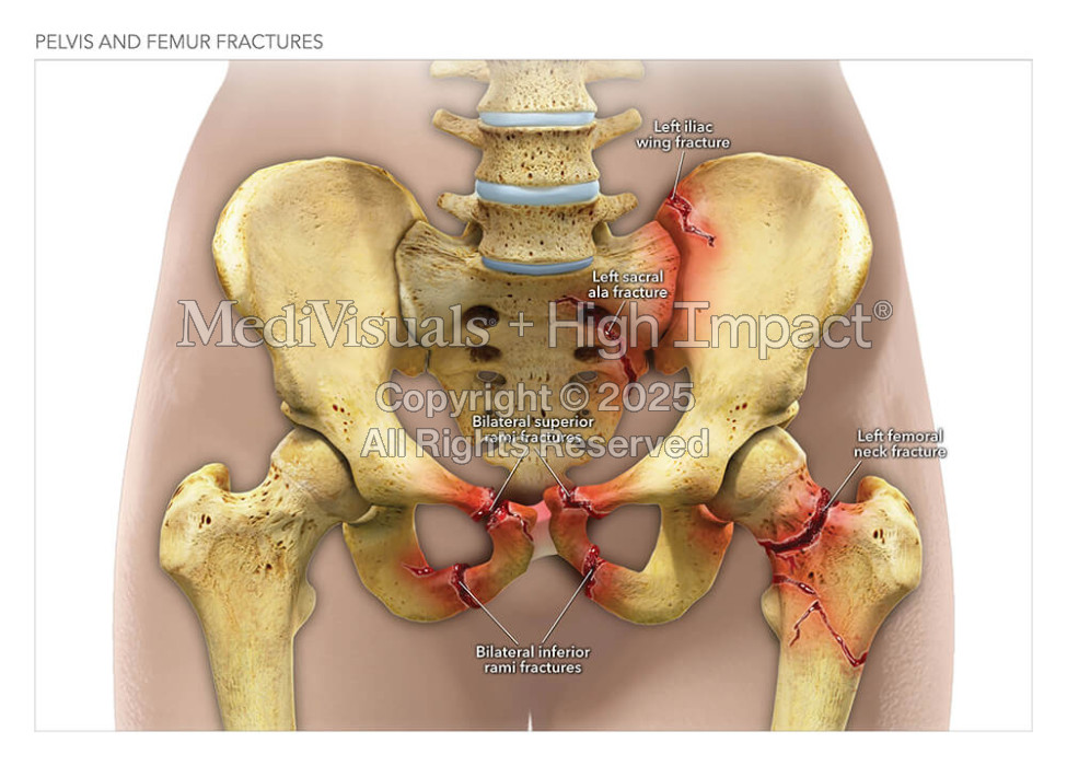 Pelvis and Femur Fractures