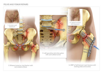 Pelvis and Femur Repairs