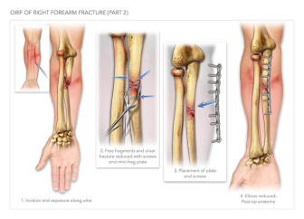 ORIF of Right Forearm Fracture (Part 2)