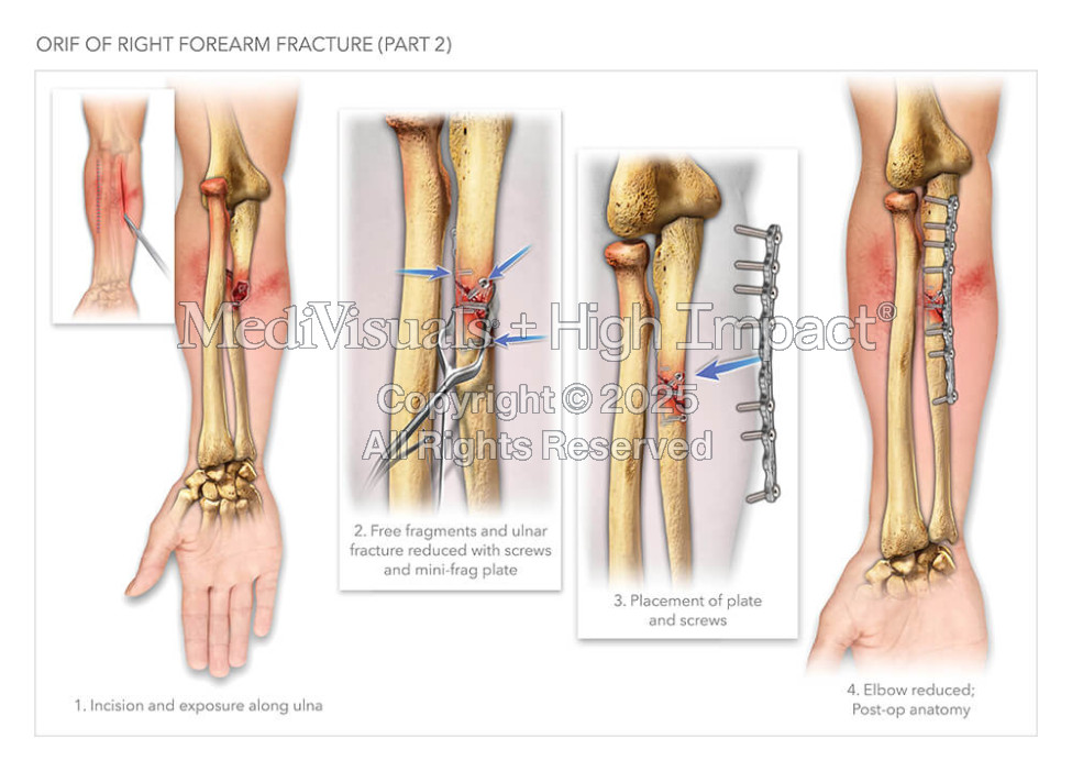ORIF of Right Forearm Fracture (Part 2)