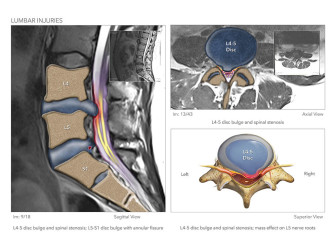 Lumbar Injuries