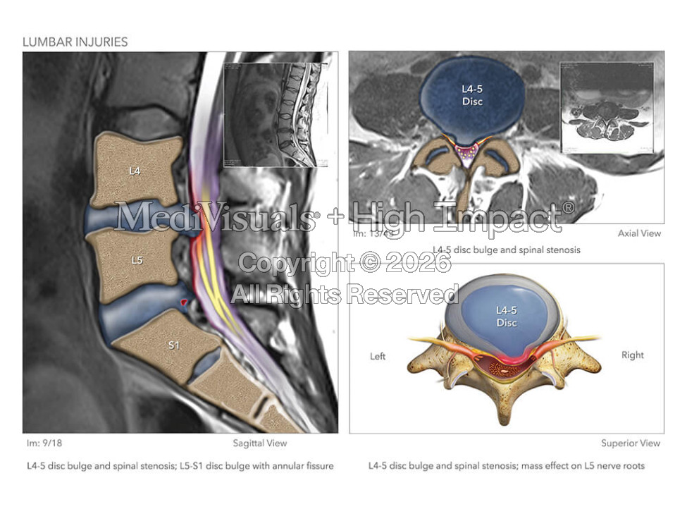 Lumbar Injuries