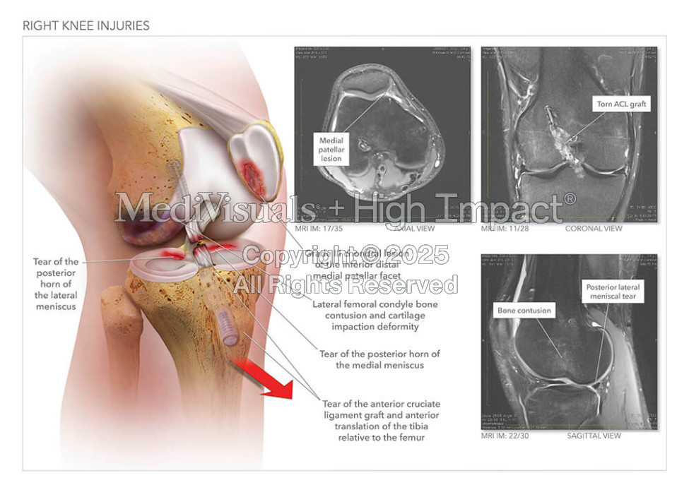 Right Knee Injuries