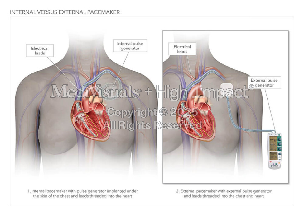 Internal Versus External Pacemaker