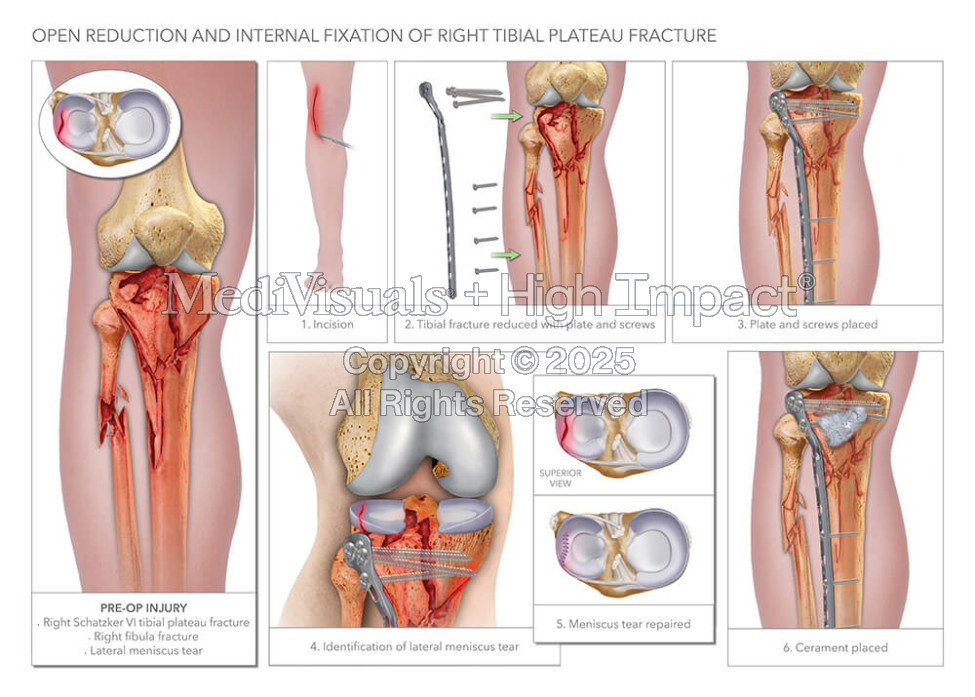 Open Reduction and Internal Fixation of Right Tibial Plateau Fracture