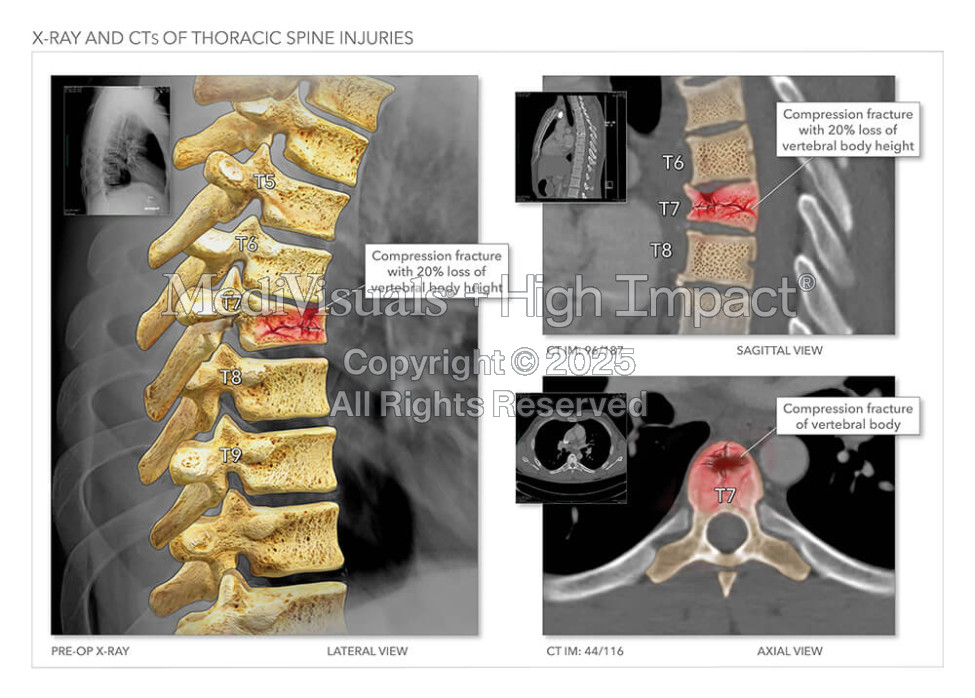 X-Ray and CTs of Thoracic Spine Injuries