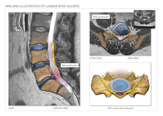 MRIs and Illustration of Lumbar Spine Injuries