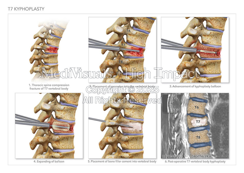T7 Kyphoplasty