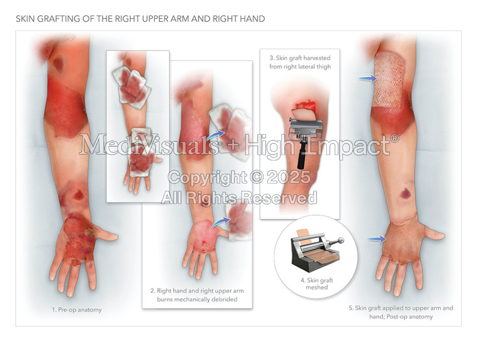 Skin Grafting of the Right Upper Arm and Right Hand