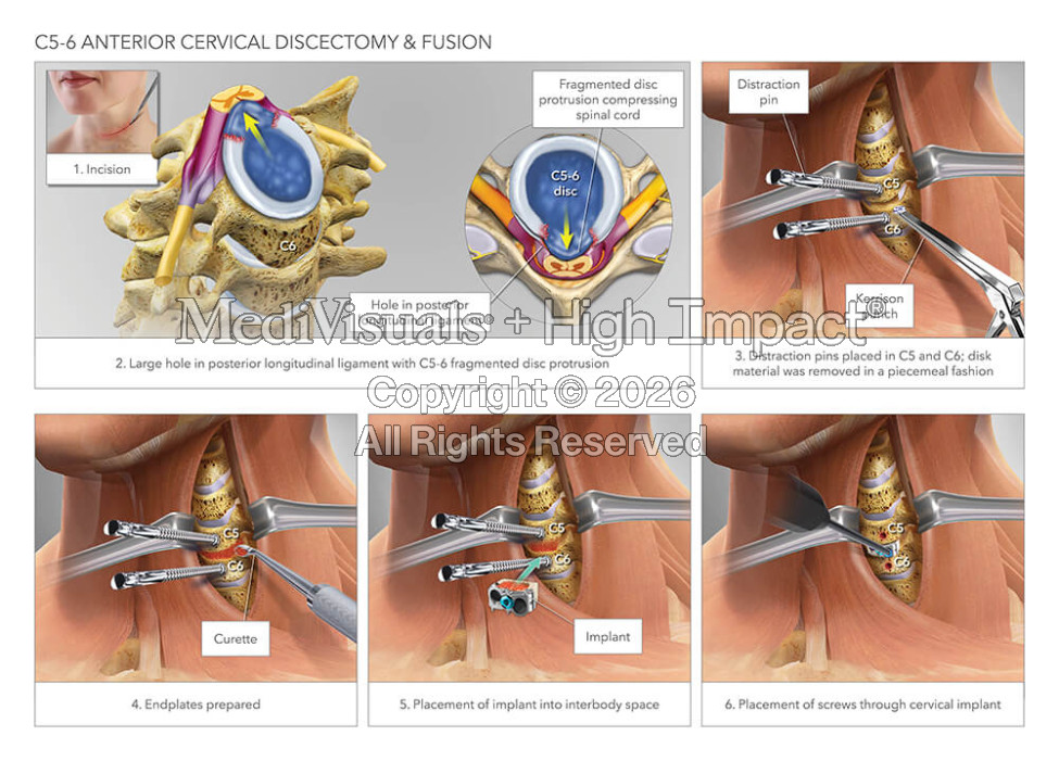 C5-6 Anterior Cervical Disectomy & Fusion