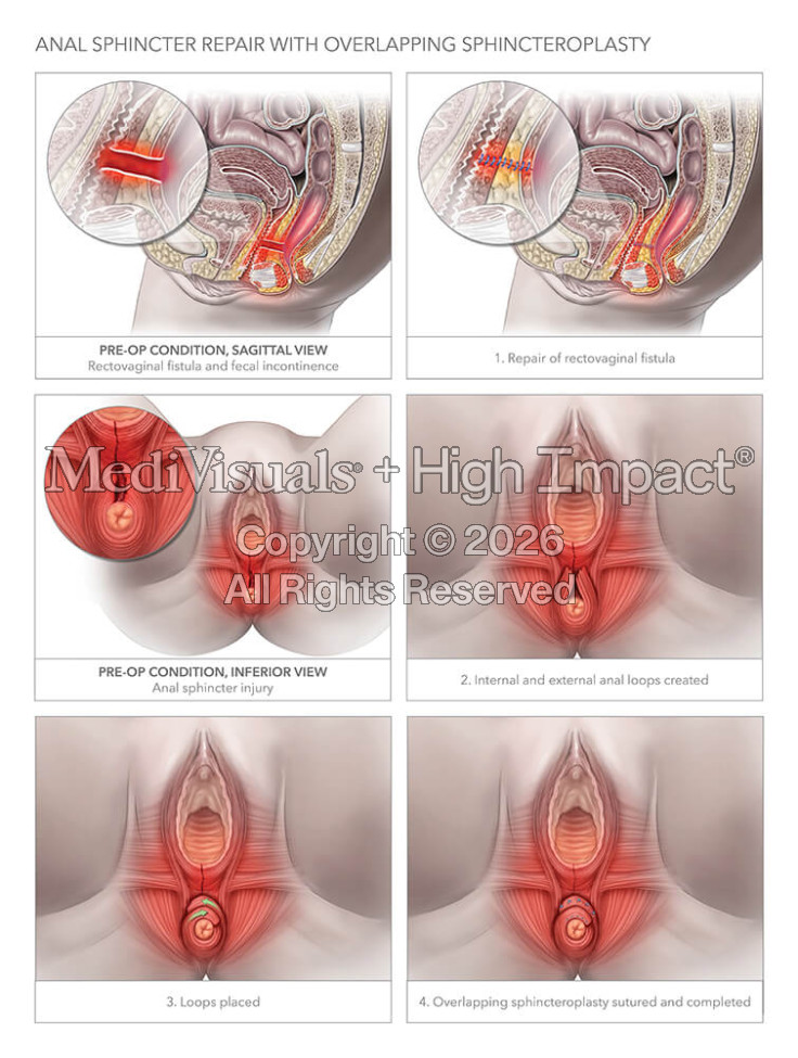 Anal Sphincter Repair with Overlapping Sphincteroplasty