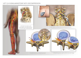 Left L3-4 Hemilaminotomy with Decompression