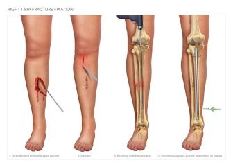 Right Tibia Fracture Fixation