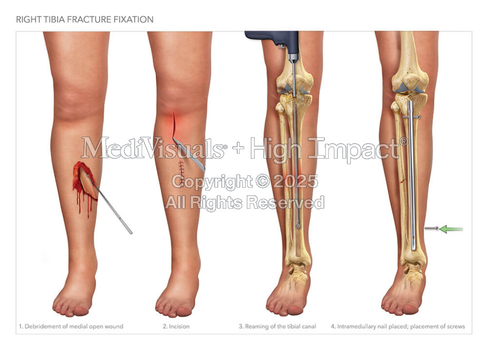 Right Tibia Fracture Fixation