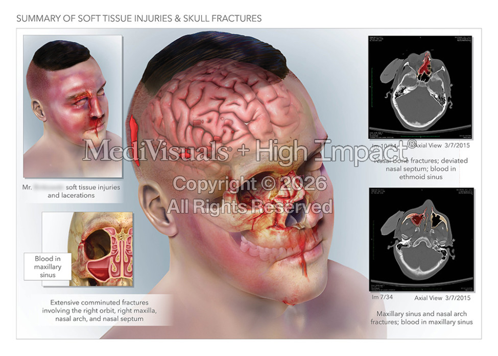 Summary of Soft Tissue Injuries & Skull Fractures