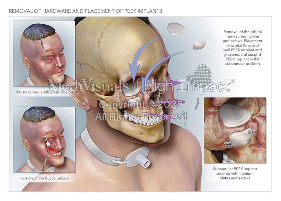 Removal of Hardware and Placement of PEEK Implants