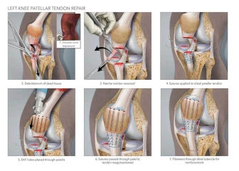 Left Knee Patellar Tendon Repair