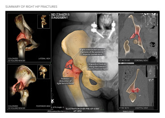 Summary of Right Hip Fractures