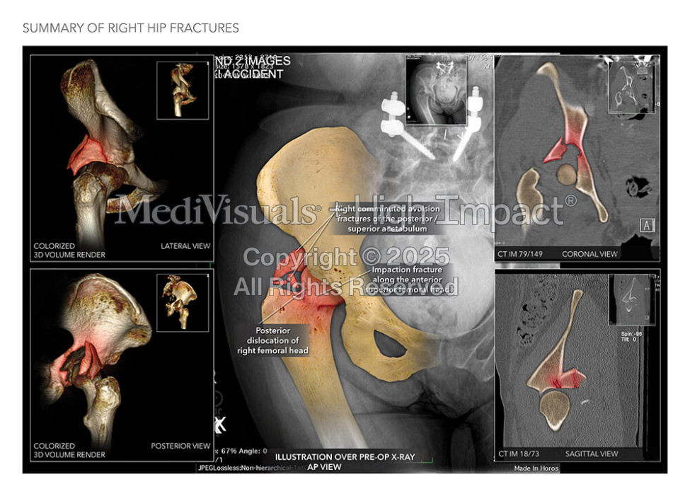Summary of Right Hip Fractures