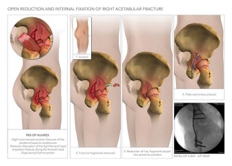Open Reduction and Internal Fixation of Right Acetabular Fracture