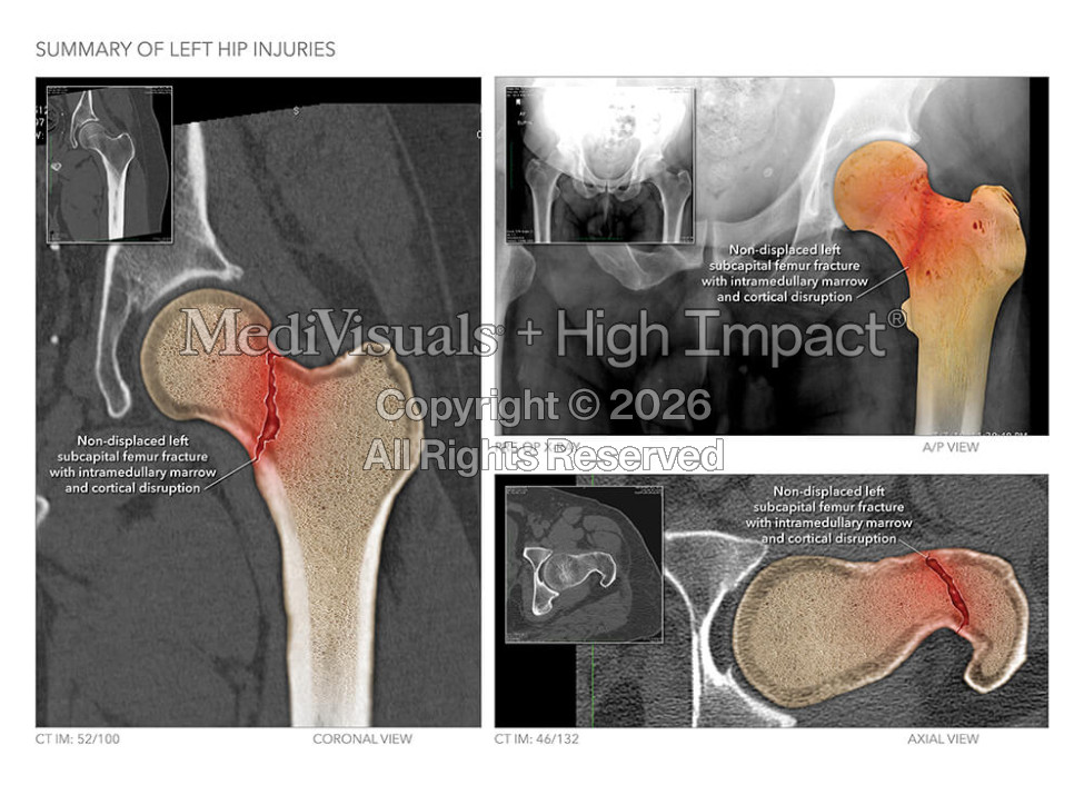 Summary of Left Hip Injuries