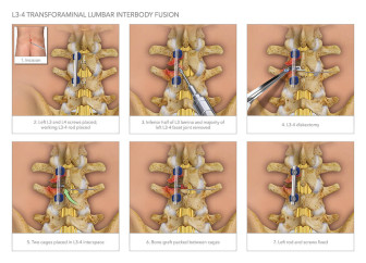 L3-4 Transforaminal Lumbar Interbody Fusion