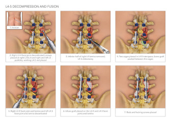 L4-5 Decompression and Fusion