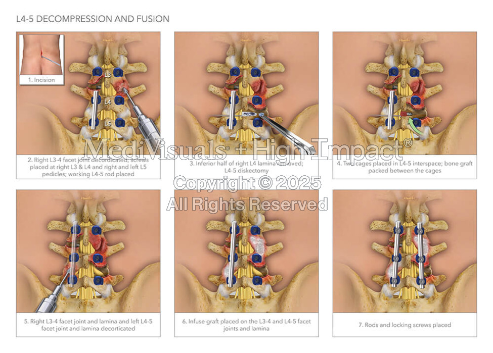 L4-5 Decompression and Fusion