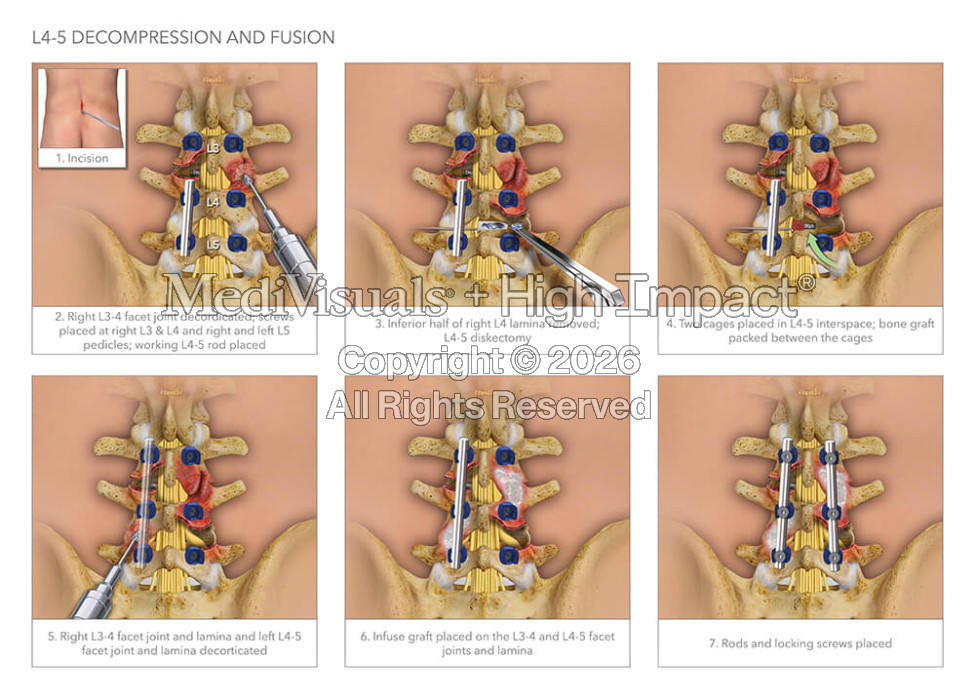 L4-5 Decompression and Fusion