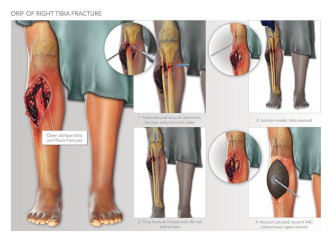 ORIF of Right Tibia Fracture